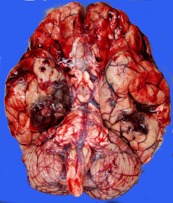 2B2 Metastases, melanoma (Case 2) _2