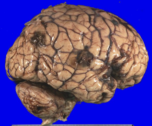 2B3 Metastases, melanoma (Case 2) _7