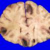 2B4 Metastases, melanoma (Case 2) _12