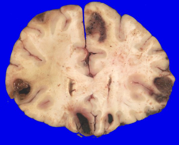 2B4 Metastases, melanoma (Case 2) _12