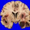 2B5 Metastases, melanoma (Case 2) _14