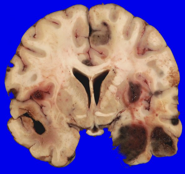 2B5 Metastases, melanoma (Case 2) _14