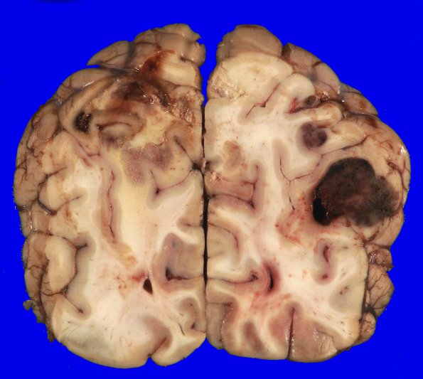 2B6 Metastases, melanoma (Case 2) _21