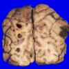 2B7 Metastases, melanoma (Case 2) _22