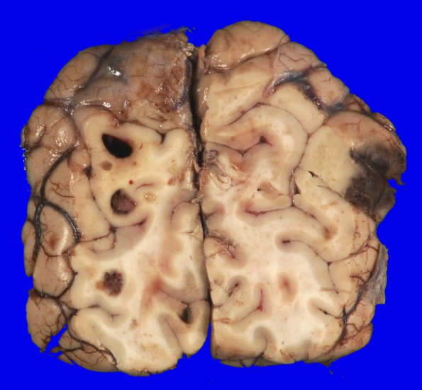 2B7 Metastases, melanoma (Case 2) _22