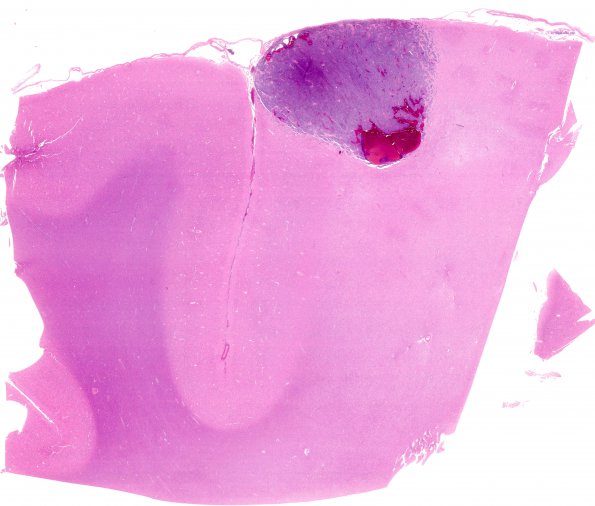 2C1 Metastases, melanoma (Case 2) H&E whole mount