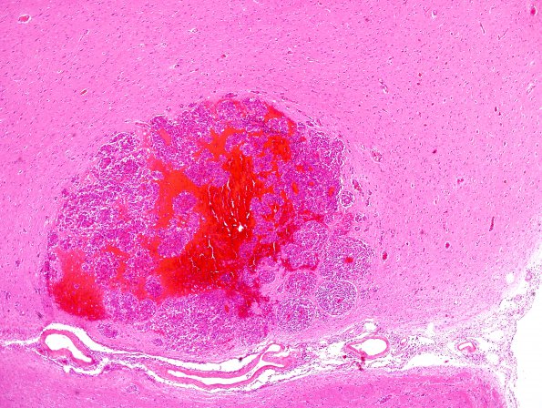 2C2 Metastases, melanoma (Case 2) H&E 6.jpg