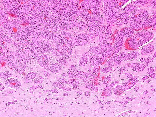 2C3 Metastases, melanoma (Case 2) H&E 4.jpg