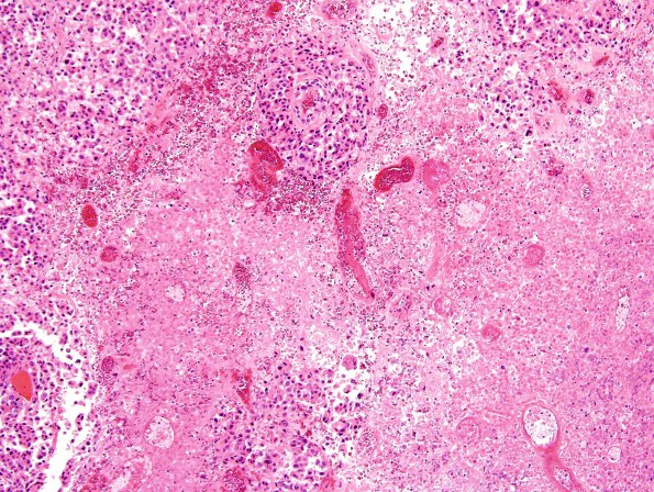 2C4 Metastases, melanoma (Case 2) H&E 7.jpg