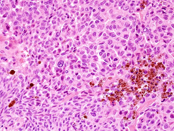 2C5 Metastases, melanoma (Case 2) H&E 1.jpg