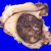 3A1 Metastases Melanoma (Case 3) gross 1