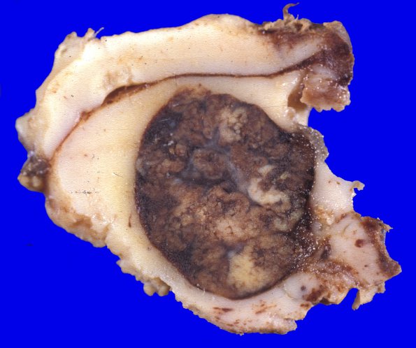 3A1 Metastases Melanoma (Case 3) gross 1