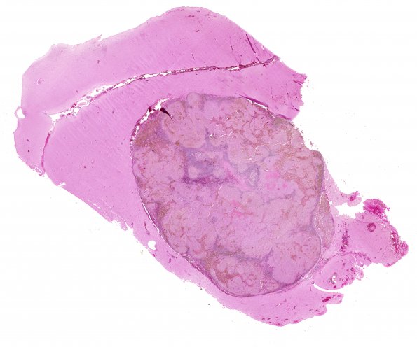 3B1 Metastasis, melanoma (Case 3) H&E whole mount