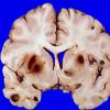 4A Metastases Melanoma (Case 4)