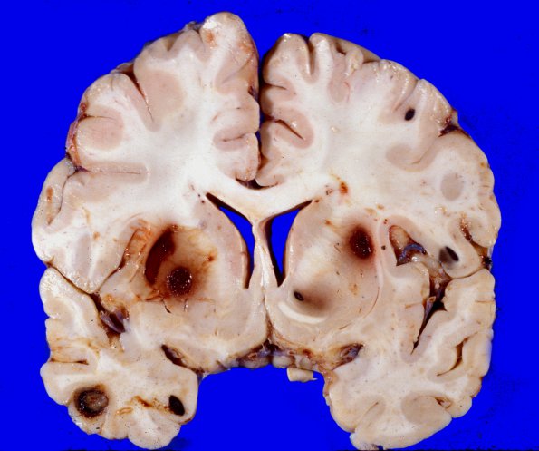 4A Metastases Melanoma (Case 4)