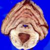 5A2 Metastases Melanoma (Case 5) c