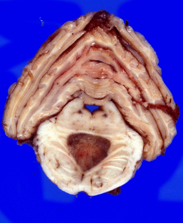 5A2 Metastases Melanoma (Case 5) c