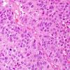 6A1 Many faces of Melanoma, metastasis (Case 6A) H&E 1.jpg