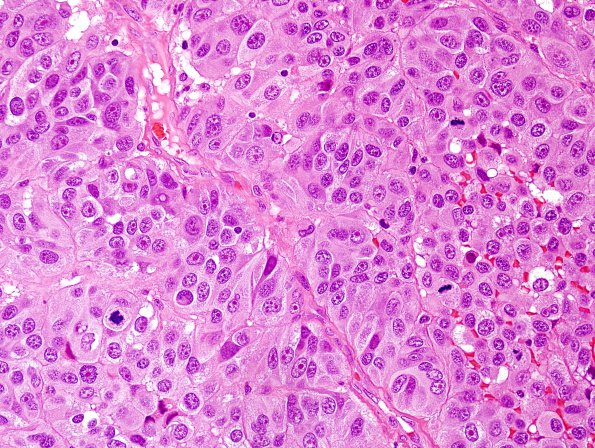 6A1 Many faces of Melanoma, metastasis (Case 6A) H&E 1.jpg