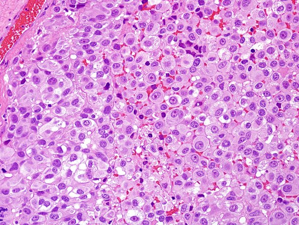 6A2 Melanoma, metastasis (Case 6A) H&E 2.jpg