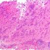 6B1 Melanoma, metastatic (Case 6B) H&E 3