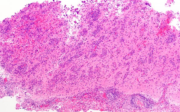 6B1 Melanoma, metastatic (Case 6B) H&E 3