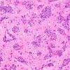 6B2 Melanoma, metastatic (Case 6B) H&E 4