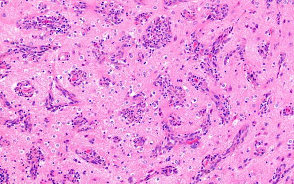 6B2 Melanoma, metastatic (Case 6B) H&E 4