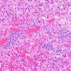 6B3 Melanoma, metastatic (Case 6B) H&E 1