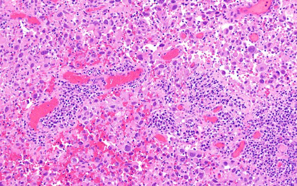 6B3 Melanoma, metastatic (Case 6B) H&E 1