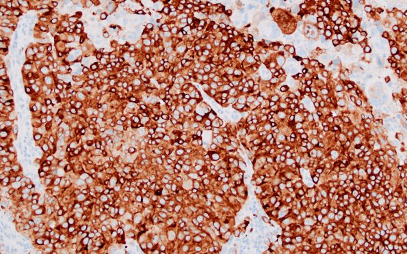 6B5 Melanoma, metastatic (Case 6B) Melan A