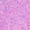 6C1 Melanoma, metastatic (Case 6C) H&E 1