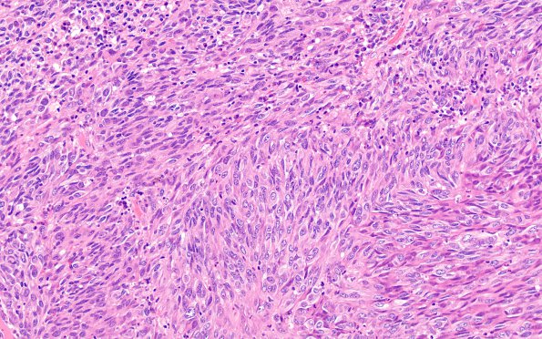 6C1 Melanoma, metastatic (Case 6C) H&E 1