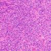 6C2 Melanoma, metastatic (Case 6C) H&E 2