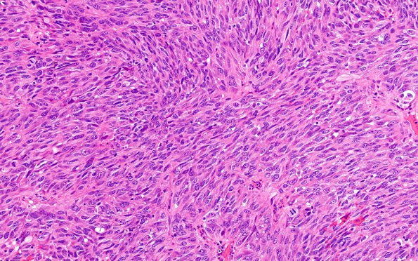 6C2 Melanoma, metastatic (Case 6C) H&E 2