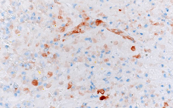 6D1 Melanoma, metastatic (Case 6D) Melan-A 40X