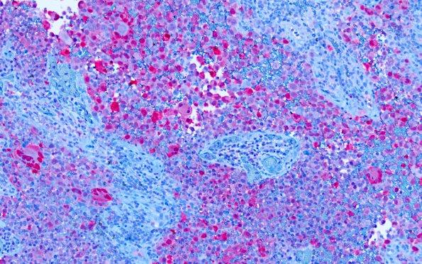 6E Melanoma, metastatic (Case 6E) S100