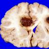 6F Metastases Melanoma (Case 6F) a