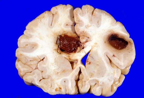 6F Metastases Melanoma (Case 6F) a