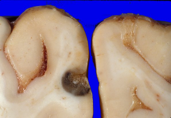 6H Metastases (WUMS Case) melanoma 3