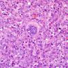 6J Metastases, melanoma (Case 6J) H&E 2.jpg