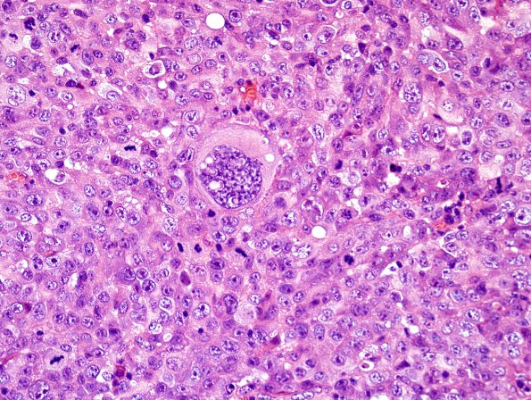 6J Metastases, melanoma (Case 6J) H&E 2.jpg