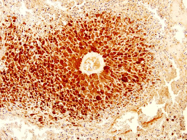 6L1 Metastases Melanoma (Case 6K) S-100 1