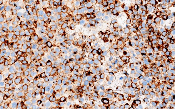 6L2 Metastases, melanoma (Case 6L) HMB-45 1