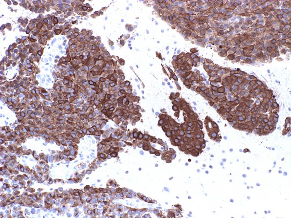 6M1 Metastases, Melanoma (Case 6M) HMB45