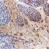 6M2 Metastases, Melanoma (Case 6M) GFAP