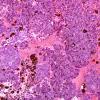 6N1 Metastasis, melanoma (Case 6N) H&E 4.jpg