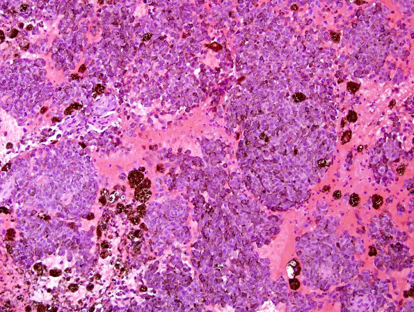 6N1 Metastasis, melanoma (Case 6N) H&E 4.jpg