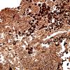 6N2 Metastasis, melanoma (Case 6N) HMB-45 2.jpg