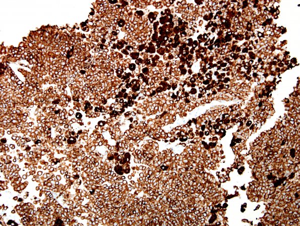 6N2 Metastasis, melanoma (Case 6N) HMB-45 2.jpg